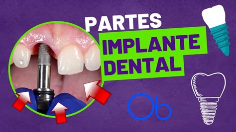 PARTES DEL IMPLANTE DENTAL YouTube