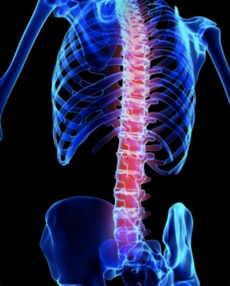 Back Pain Suspected Ankylosing Spondylitis Spondyloarthritis Msk