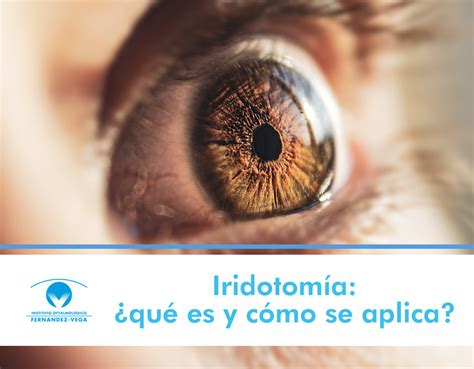 Iridotomía qué es y cómo se aplica en el tratamiento del glaucoma