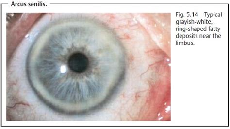 Limbus Sign And Arcus Senilis
