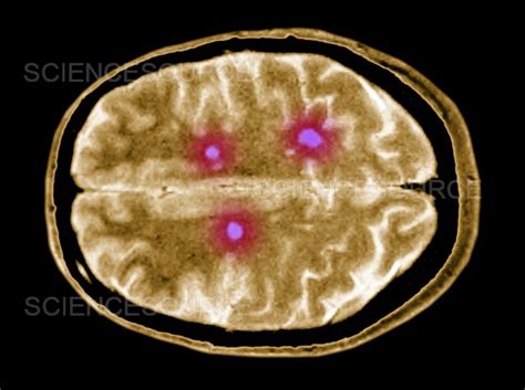 Photograph | Multiple sclerosis brain lesions | Science Source Images