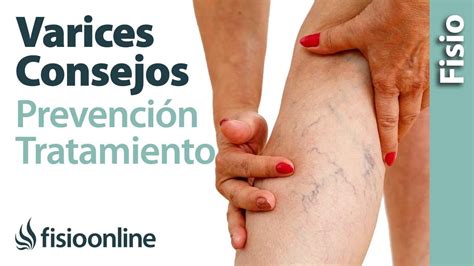 Varices Mala Circulación Y Piernas Cansadas 10 Claves Para Su