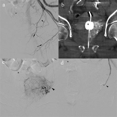 A Selective Digital Subtraction Angiography Dsa In The Left