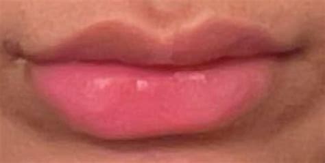 Lip Filler Journey R Plasticsurgery