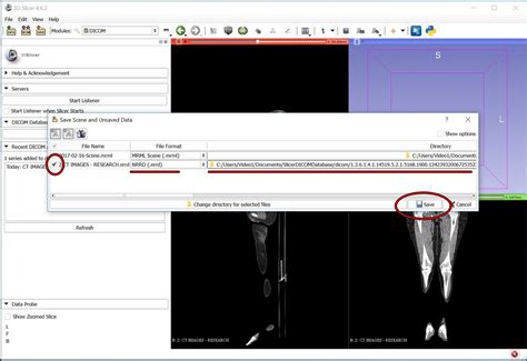 How To Easily And Automatically Convert A Ct Scan Dicom Data Into A 3d Printable Medical Model