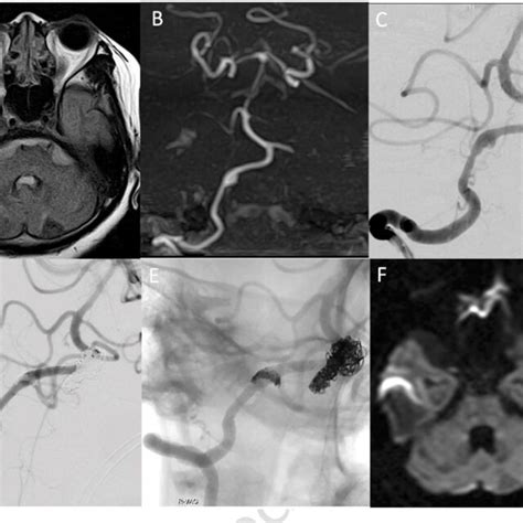 A Flair Image On Admission Shows Subarachnoid Hemorrhage In The Download Scientific Diagram