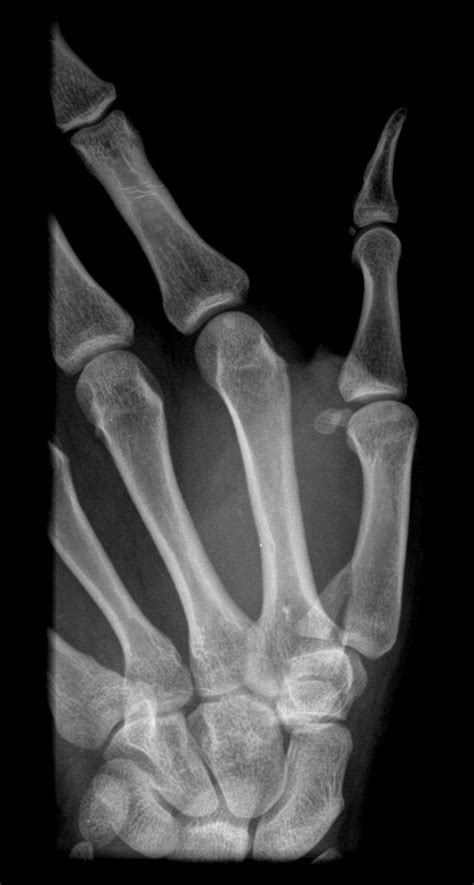 Classification Of The Bennett S Fracture Wikidoc