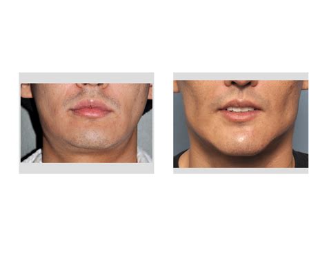 External Effects Of Facial Implants Plastic Surgeon Dr Barry L