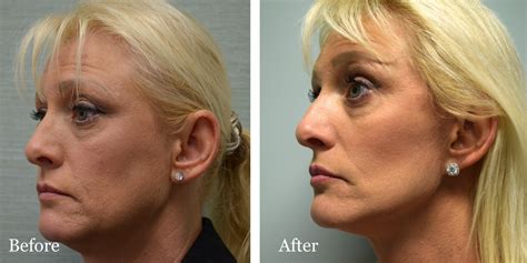 Mini Facelift vs Full Facelift