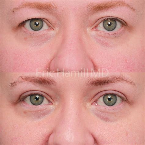 Upper Eyelid Blepharoplasty — Eric Hamill Md Eye And Face Plastic Surgery