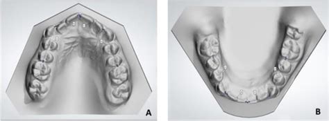 Fig 1a B Measurements Of Mesiodistal Width Of Each Tooth From The