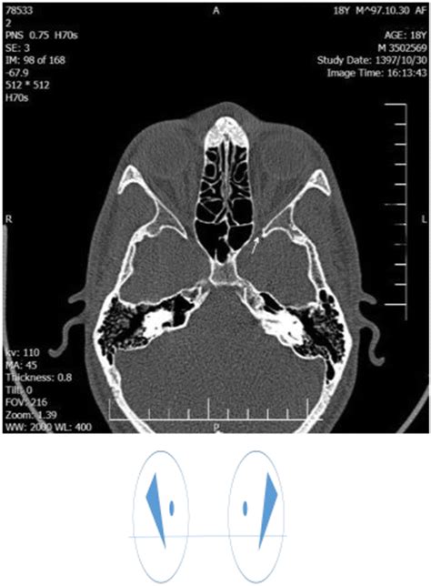 Superior Orbital Fissure Radiology