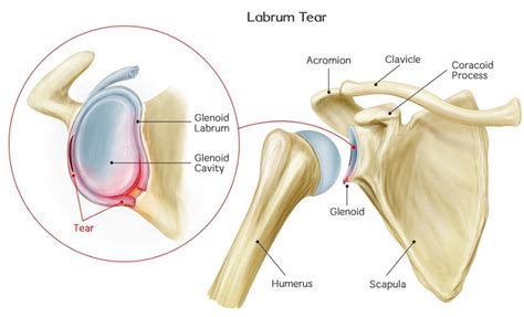 Shoulder Labral Tear Dr Anjans Orthopaedic Center