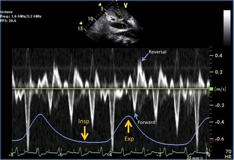 Echocardiographic Diagnosis Of Constrictive Pericarditis Circulation