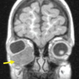 (a, b) MRI images demonstrate heterogeneously enhancing 2.7 cm ...