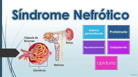 Síndrome Nefrótico y nefrítico Síndrome nefrótico Medicina humana