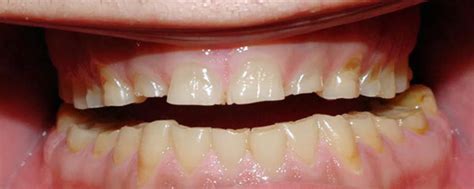 Bruxism Causes And Treatments