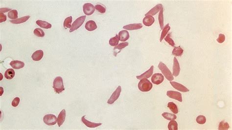 Sickle Cell Disease In Babies Sickle Cell Anemia Causes Symptoms