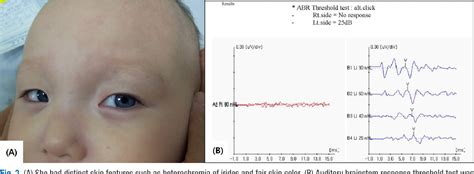 Figure 1 From The First Korean Case Of Waardenburg Shah Syndrome With Novel Endothelin Receptor