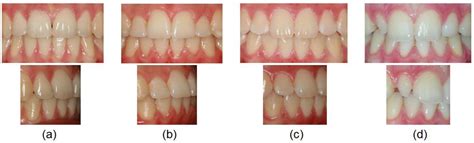 Maxillary Lateral Incisor