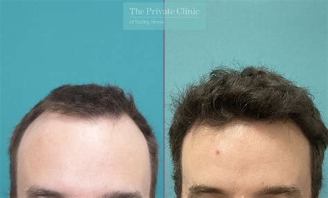 Fue Hair Transplant 050mm Side The Private Clinic Of Harley Street London