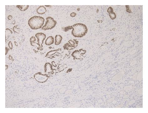 Pathologic Examination Of The Excised Mass Hematoxylin And Eosin