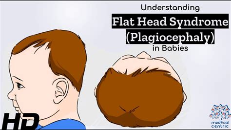 Plagiocephaly Positional Plagiocephaly Flat Head 46 Off