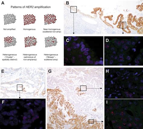 Histopathologic Features And Molecular Genetic Landscape Of HER2