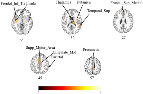 Cross Sectional View Of The Difference In Brain Activation Range Download Scientific Diagram