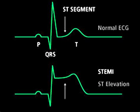 Stemi Infark Miokard Dengan St Elevasi Ina Ecg