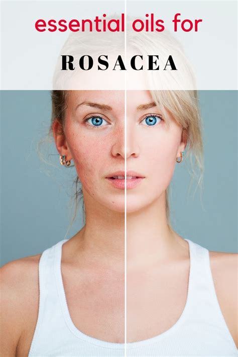 Essential Oils For Rosacea Best Essential Oils Essential Oil Recipes