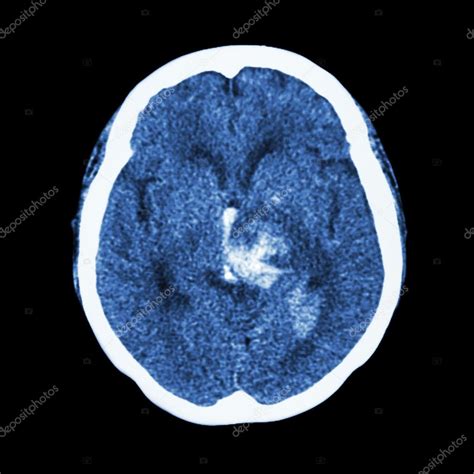 Tomografía Computarizada Del Cerebro Muestra Accidente Cerebrovascular