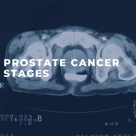 Prostate Cancer Stages - Man Cave Health