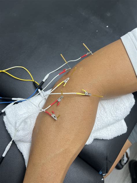 The Ultimate Guide To Dry Needling Hercules Performance And Physical