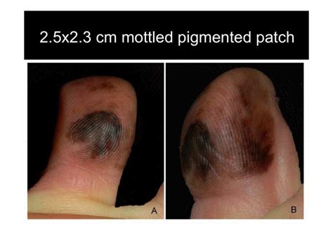 Acral Lentiginous Malignant Melanoma