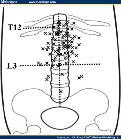 Safe Gastric Puncture Point Before Percutaneous Endoscopic Gastrostomy