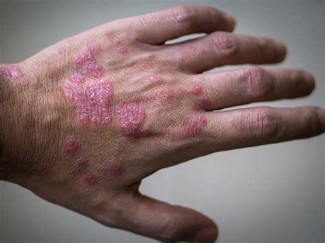 Psoriasis Causes Triggers Treatment And More Thehealthsite