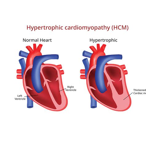 How Is Hypertrophic Cardiomyopathy Passed On The Tech Interactive