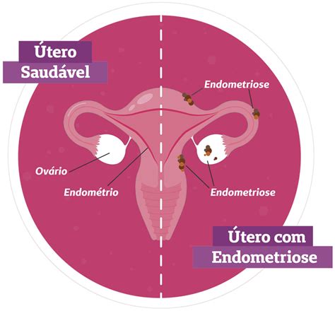 O Que E Endometriose Entenda O Que E Essa Doenca Conheca Os Sintomas