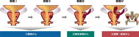 前立腺がんについて 医療法人社団實理会 東京国際大堀病院