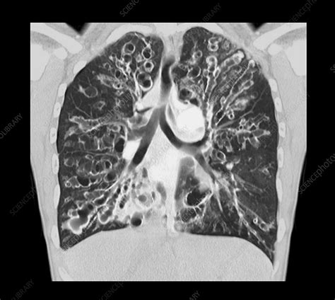 Cystic Fibrosis Ct Scan Stock Image C0525787 Science Photo Library