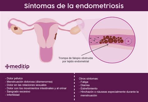 Endometriosis Causas Diagnóstico Y Tratamiento Meditip