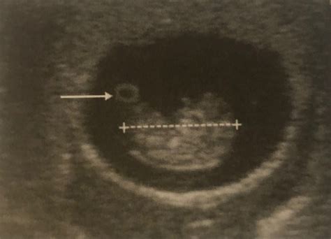 First Trimester Davies Second And Third Trimesters Davies