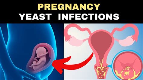 Vaginal Infection During Pregnancy