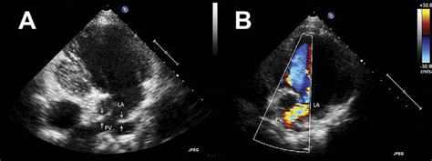 A Transthoracic Echocardiography 10 Years After Fontan Operation B