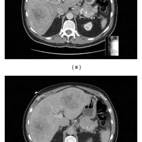 Ct Of Bilobar Hepatic Metastases From A Malignant Net In The A Download Scientific Diagram