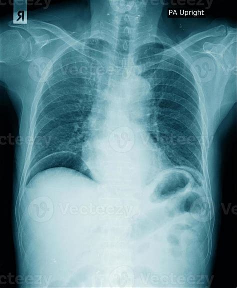 chest x-ray image in blue tone black background, lung infection with ...