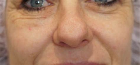 Blue Appearance Of The Dermal Filler Under The Skin Tyndall Effect