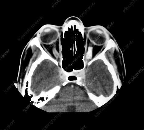 Ct Of Optic Meningioma Stock Image M Science Photo Library