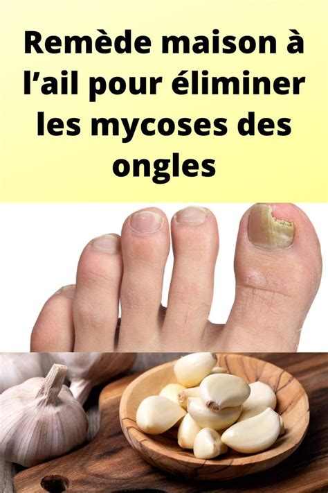 Remède maison à lail pour éliminer les mycoses des ongles French